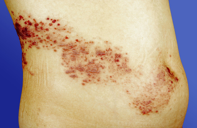 妊娠疱疹的临床特征图片