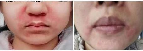 戴口罩过敏又闷痘州二医院皮肤科医生来支招