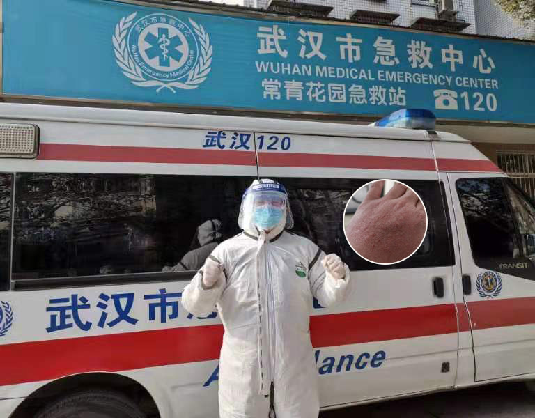 武汉加油徐迪来自武汉市中心医院胸外科疫情开始后周转于救护车和发热