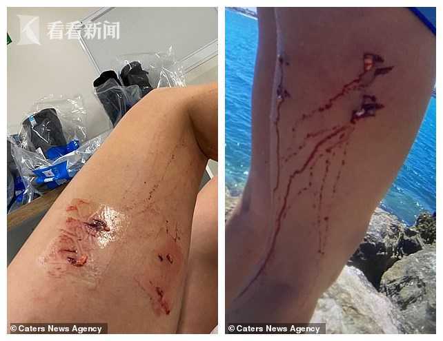 女子与海狮共舞大腿被咬好几口需手术缝合看到海狮在吸腿上的血