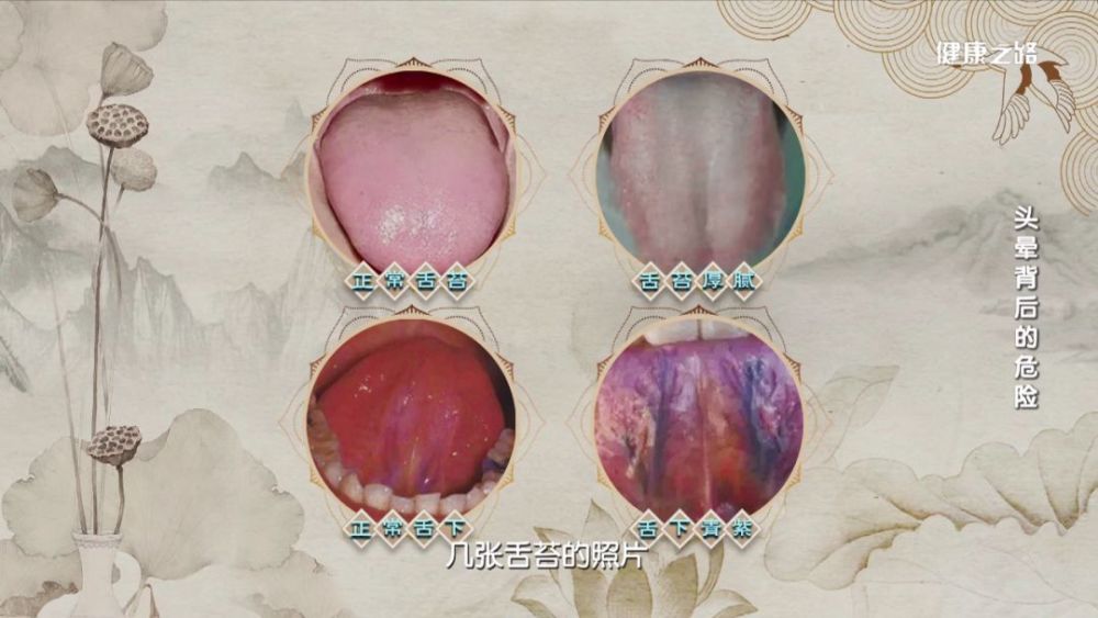 千万别轻视痰瘀互结,心梗,脑梗,甚至猝死背后都见它!