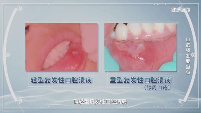 口腔溃疡反复发作？超过7天还不好？当心！腺周口疮可能来了！健康之路_腾讯新闻