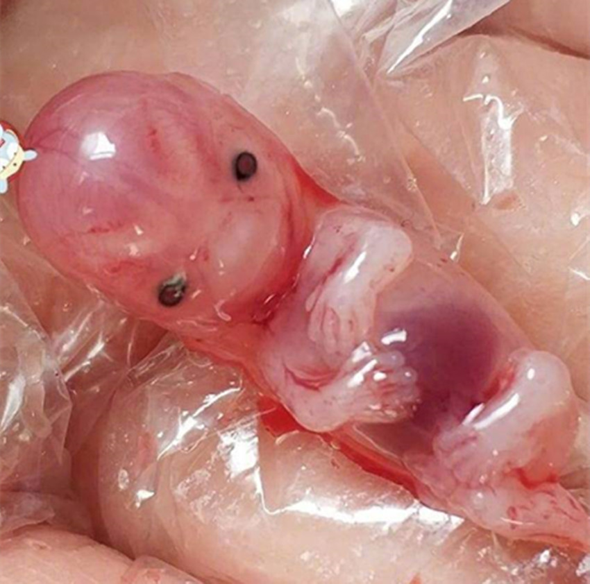 八周药流胚胎图片图片