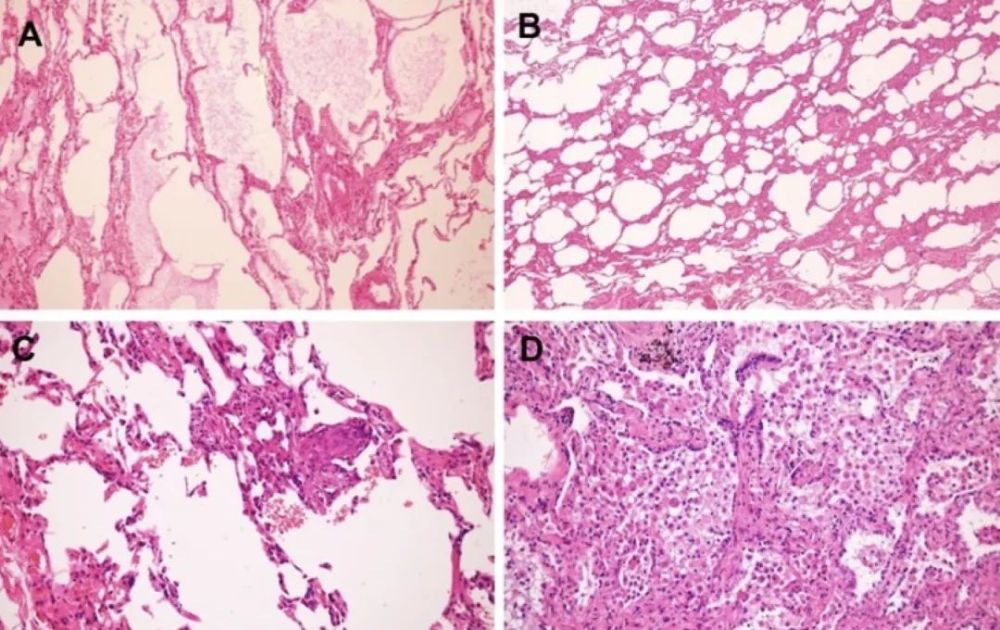 周围肺组织显示斑片状纤维蛋白渗出改变.