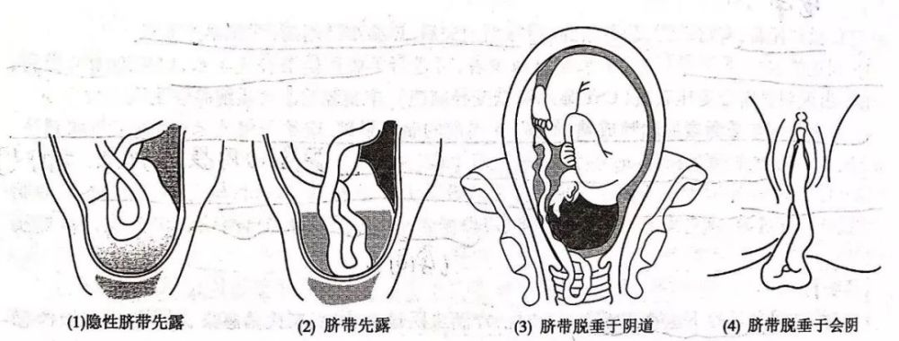 脐带脱落过程图片