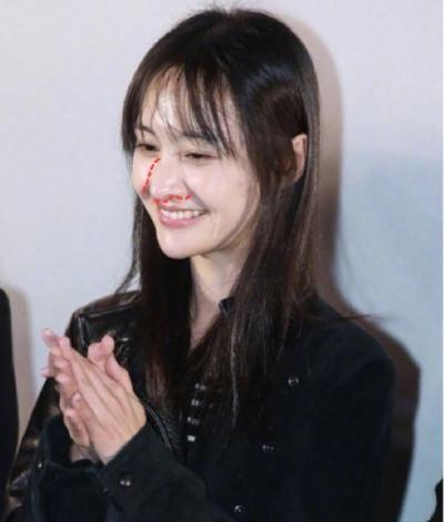 为什么杨幂,郑爽的侧面都会露鼻孔?鼻小柱下垂的问题令人烦恼
