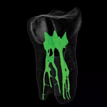 治疗牙髓炎的基本原则是消炎止疼防止再感染,根管治