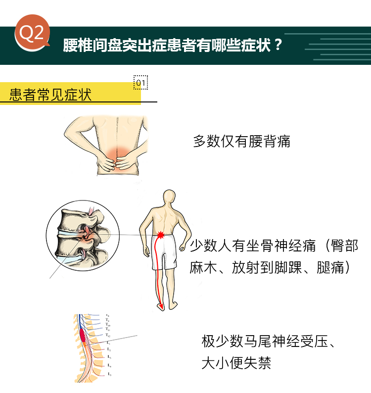 腰椎间盘突出疼痛点图图片