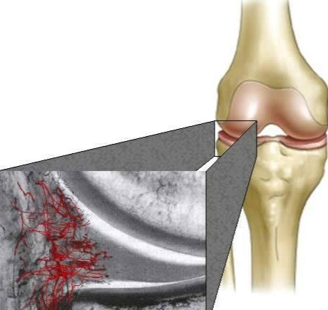 半月板缝合术后 出现膝盖肿胀 疼痛 肌肉萎缩等情况如何应对 腾讯新闻