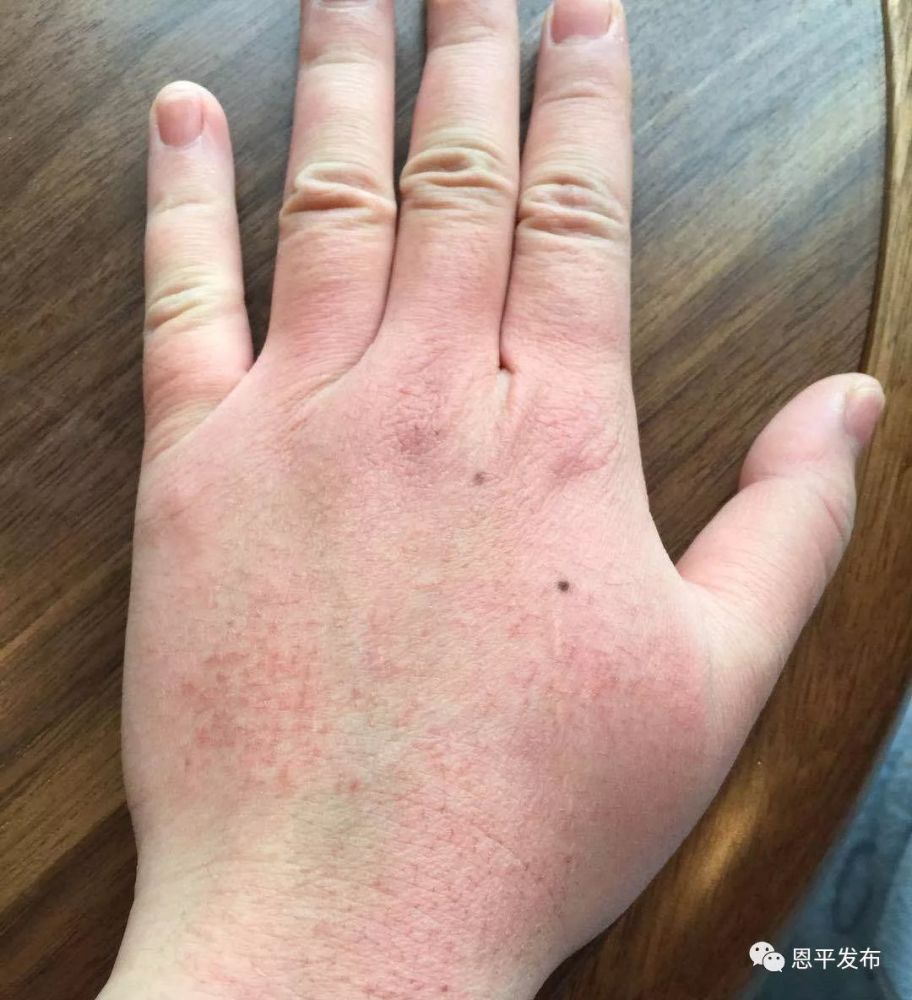 长时间戴着内有滑石粉的手套,再经过消毒液和洗手液反复侵蚀,黎雁嫒的