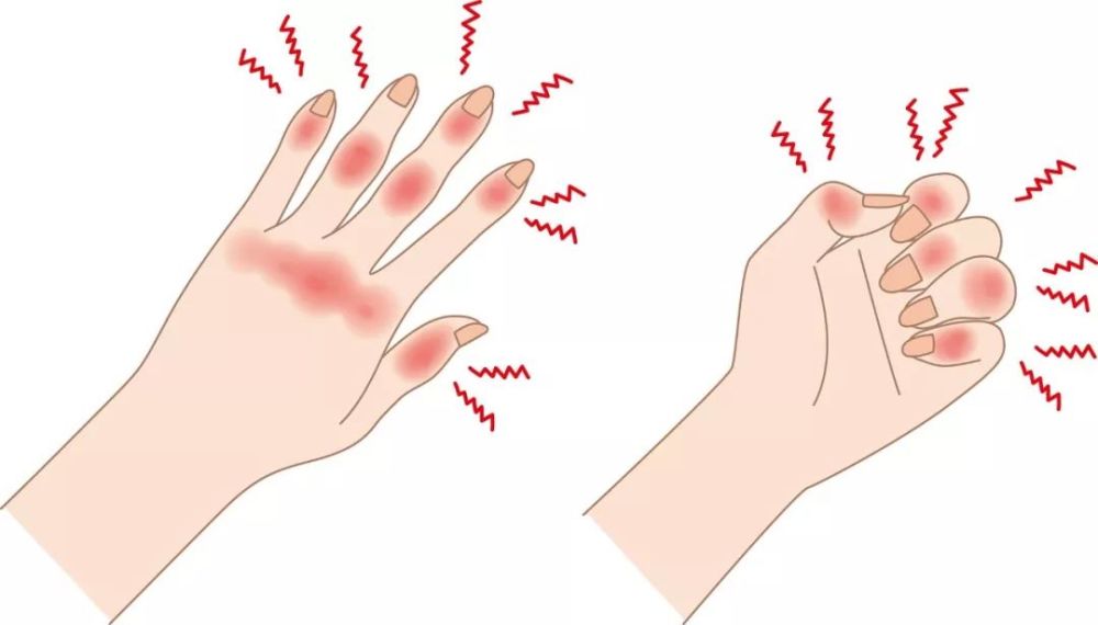 手指冻成"胡萝卜"又肿又痒,别再搓揉热水泡了!