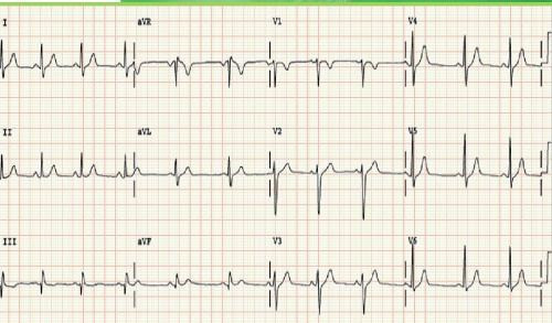 正常12导联心电图各导联波形特点 腾讯新闻