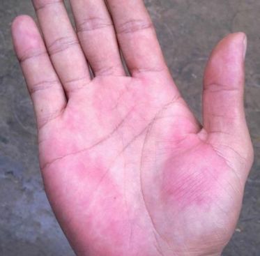 42岁男子,查出肝癌,提醒:身上出现2臭3红,尽早检查,别拖延