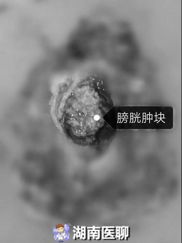 只因膀胱上的此物在作怪