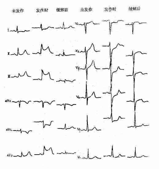 t波高尖心电图表现图片