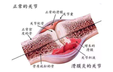 為什麼你的膝關節炎一直不好看完這篇你就明白了