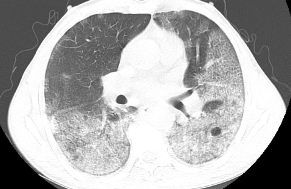刘敏:病毒性肺炎的ct影像学特征分析
