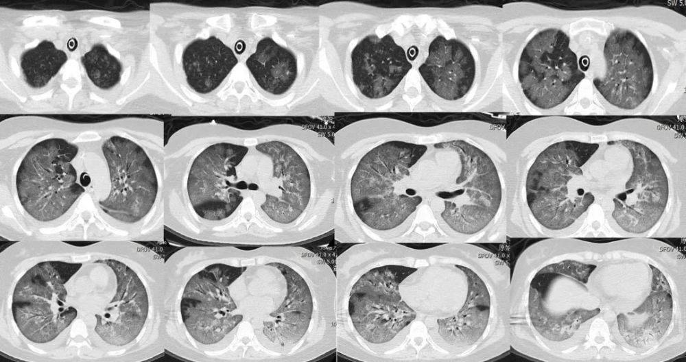 刘敏:病毒性肺炎的ct影像学特征分析