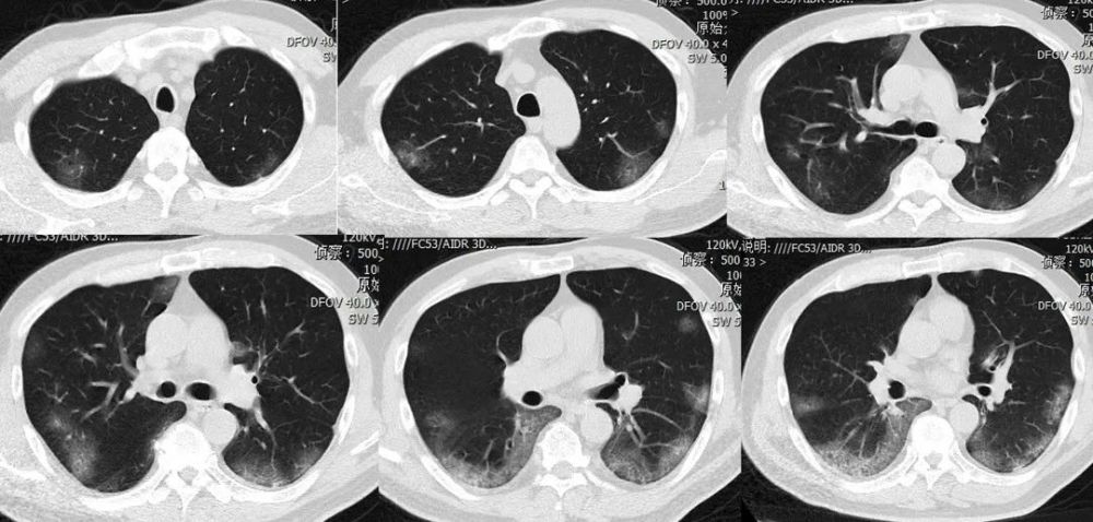 劉敏病毒性肺炎的ct影像學特徵分析