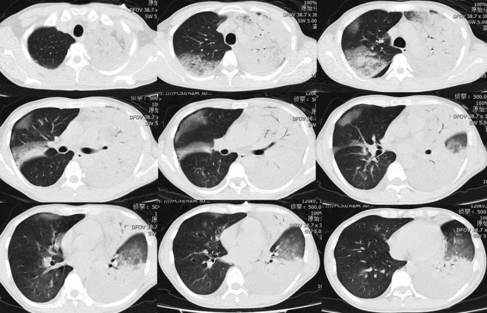 刘敏:病毒性肺炎的ct影像学特征分析