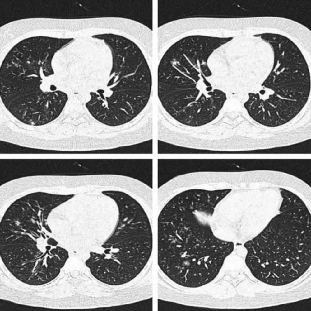病毒性肺炎ct影像图片图片
