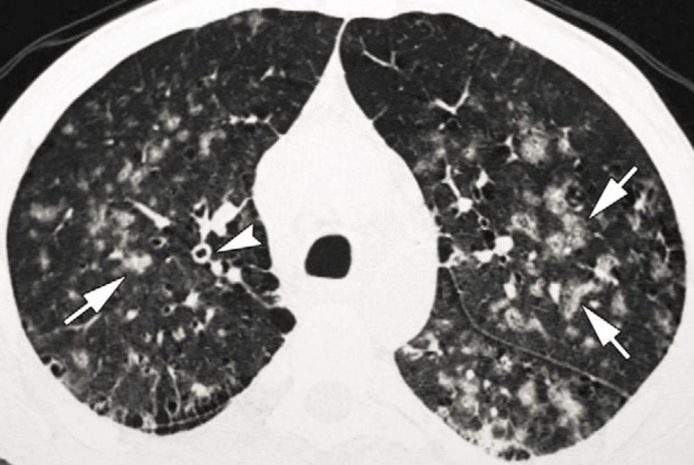 呼吸道合胞病毒肺炎:双肺小叶中心结节灶,支气管管壁增厚f58,急性髓系
