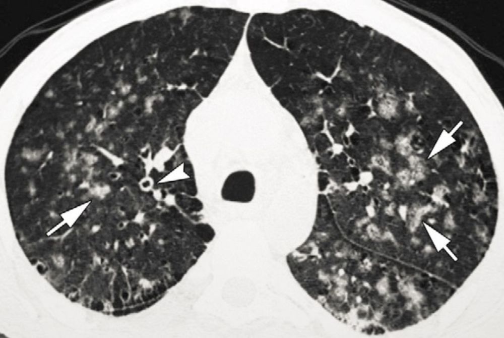 刘敏病毒性肺炎的CT影像学特征分析 腾讯新闻