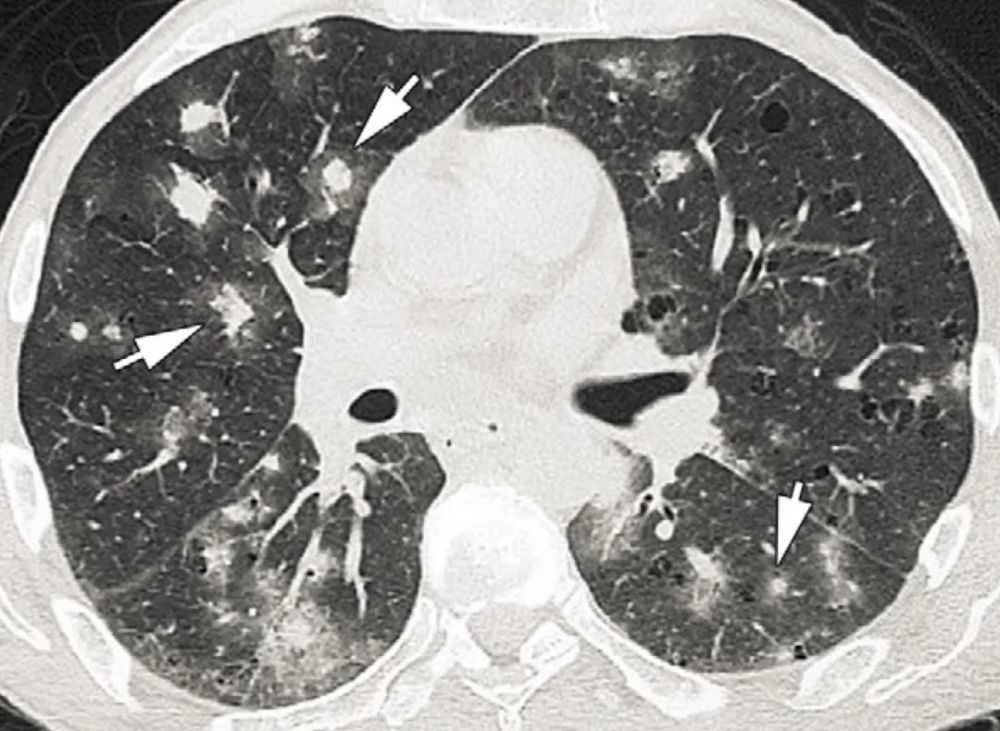 刘敏:病毒性肺炎的ct影像学特征分析