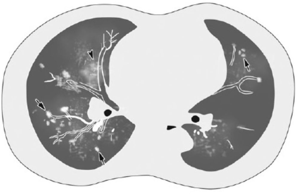 刘敏:病毒性肺炎的ct影像学特征分析