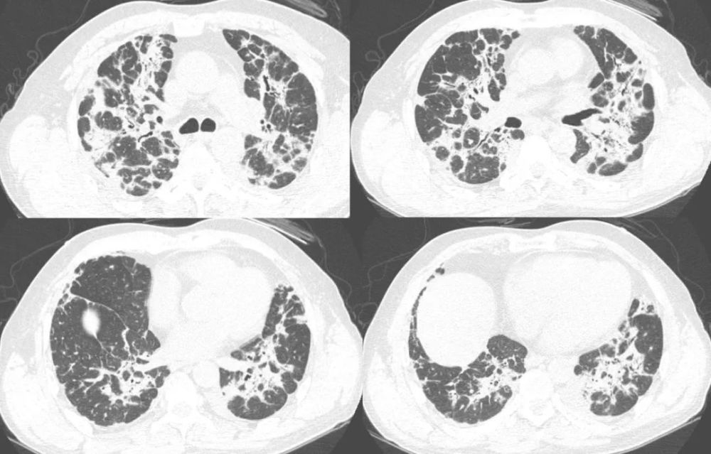 肺炎ct影像图片图片
