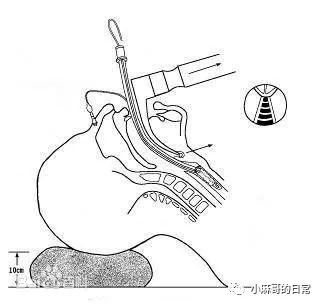 新冠肺炎患者气管插管 除了防护外 这项关键技术也很重要 腾讯新闻