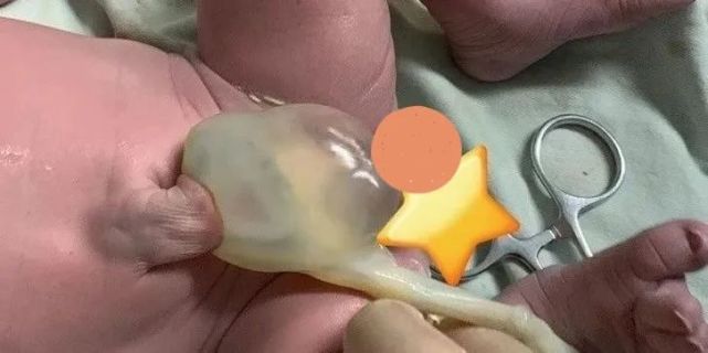 脐带囊肿指的是发生于脐带的囊肿,起源于脐尿管和卵黄管的残余部分