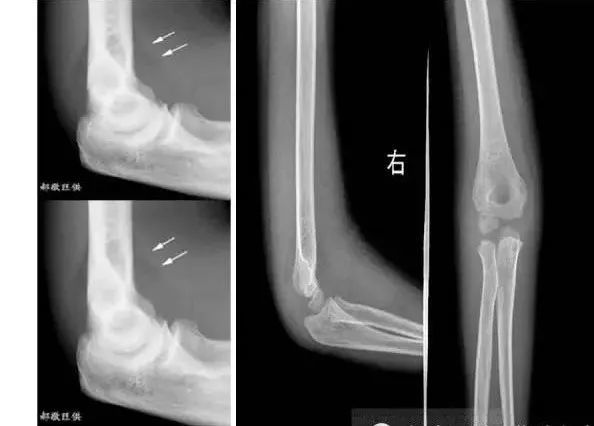 儿童肘关节骨折 腾讯新闻