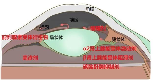 青光眼的分類和治療,一文了解!