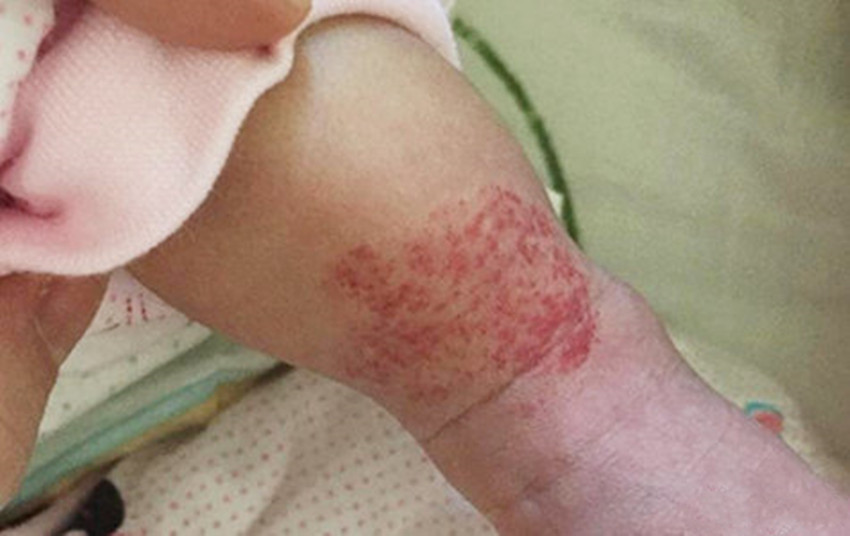 新生儿被确诊患有严重的血管瘤,希望发达的医学能将小天使治愈!