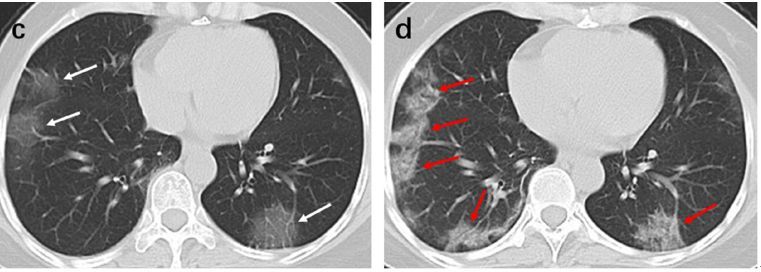 新冠肺炎感染者肺部CT有何表现?暨大研究成果