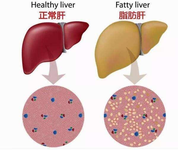 脂肪肝是可以逆转的我们需要怎么做