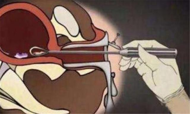 当孕妈打"引产针"时,胎儿是什么感受?网友:让人落泪的体验_腾讯新闻