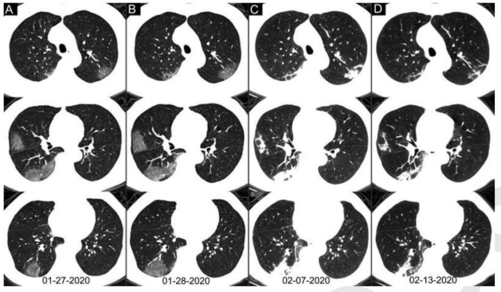 新冠患者肺部的磨玻璃樣陰影長啥樣看了本文就會了