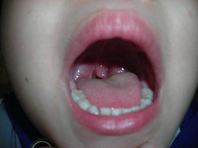 孩子身体有这些症状 很可能是扁桃体结石 家长别跟感冒混淆了 柠檬汁 扁桃 孩子 扁桃体结石 症状 扁桃体炎