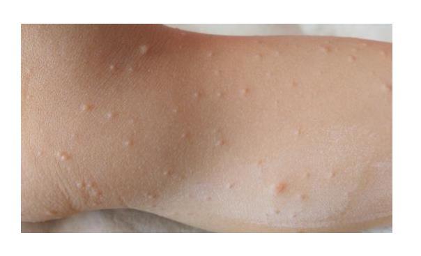 丘疹|皮肤病|小米粒|脂肪粒