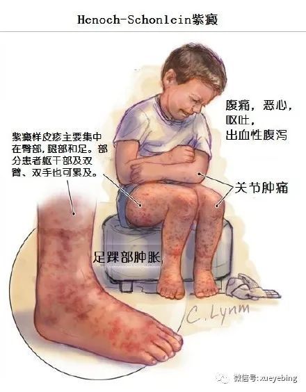 常用的过敏性紫癜中医诊疗技术大汇总 腾讯新闻