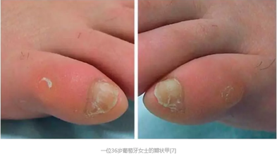 除此之外,在瑞士尼泊尔大学发表的一篇论文中,也报道了有关56位瓣状甲