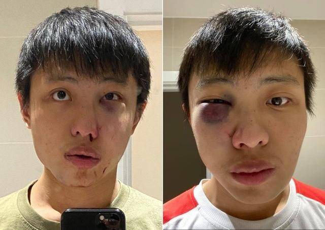 乔纳森莫称,他到医院求医后发现脸部几处有骨折,医生告诉他或许须要