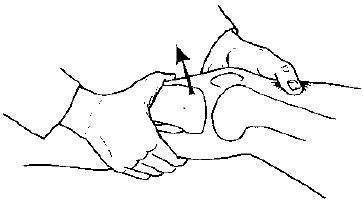 反向轴移试验:一手扶足部,另一手扶小腿,先屈曲膝关节至最大限度,同时