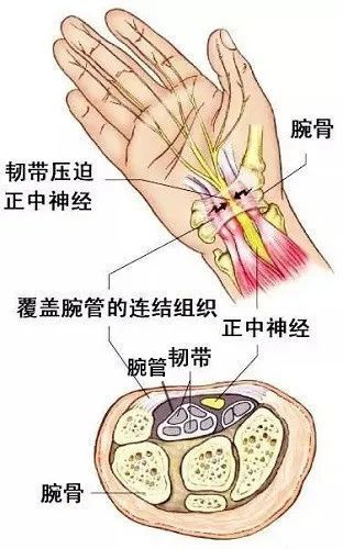 当手指,手腕长期频繁,快速地重复一个动作,导致出现的周围神经卡压,使