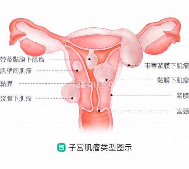 到了更年期 子宫肌瘤还治吗 妇科医生 要注意区分这4点 否则有恶变可能 肌瘤 更年期 子宫肌瘤 妇科 围绝经期