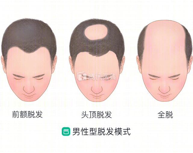 秃发会遗传给孩子？有遗传倾向，但非绝对！这3点也是导致脱发的罪魁祸首_腾讯新闻
