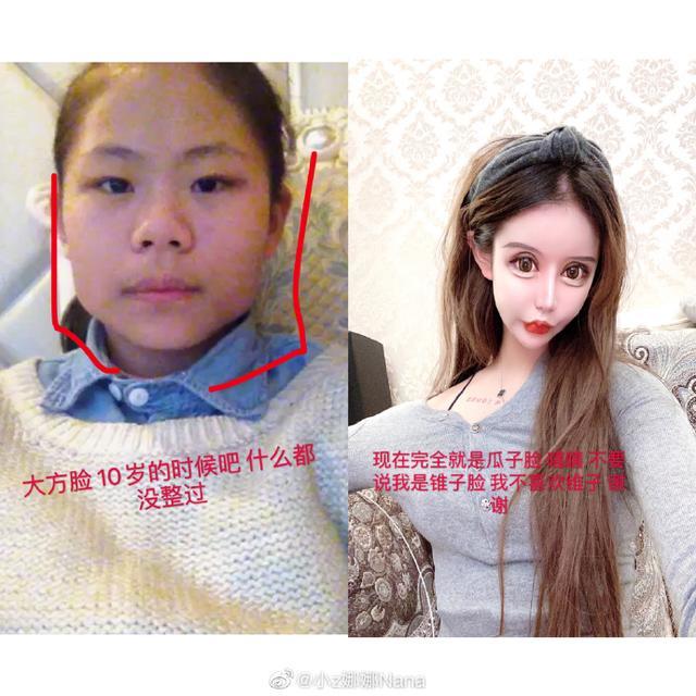 13岁整容,3年60次变"蛇精脸"被喷像鬼,她妈妈却这么说