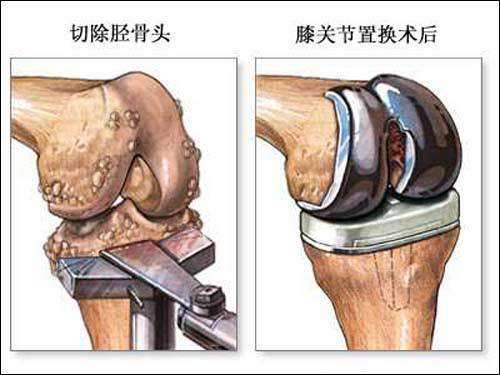 膝关节置换是什么意思 人工膝关节置换到底是怎么回事 腾讯新闻